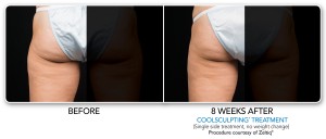 Zeltiq Coolsculpting Cleveland