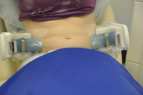 Dual CoolSculpting