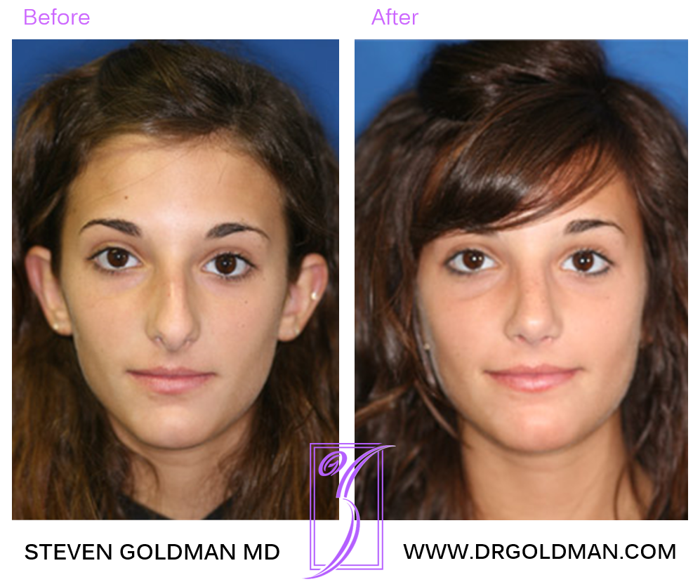 Rhinoplasty