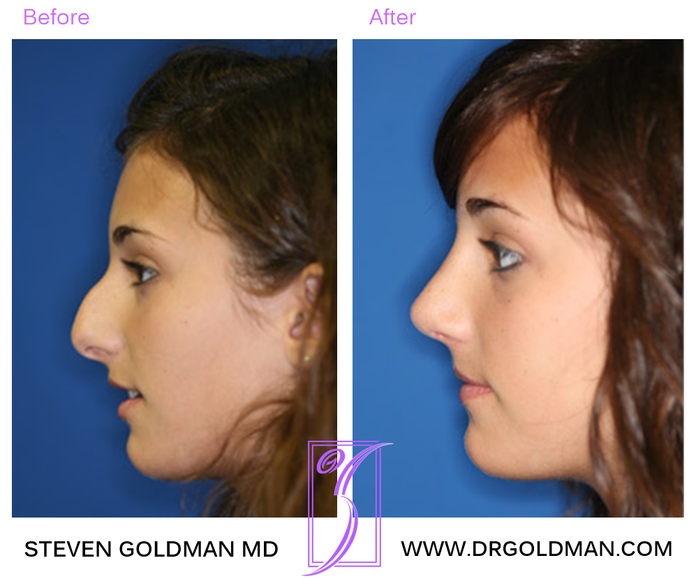 Rhinoplasty