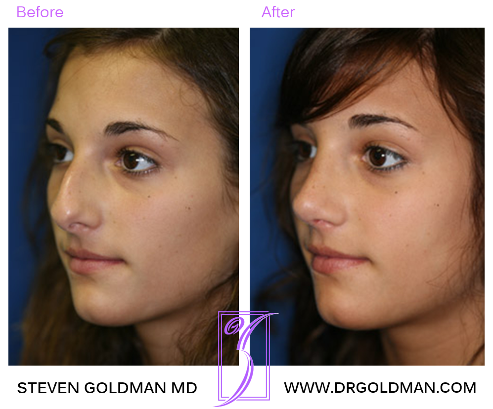 Rhinoplasty