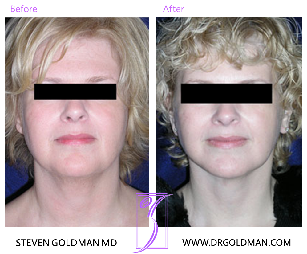 Facelift
