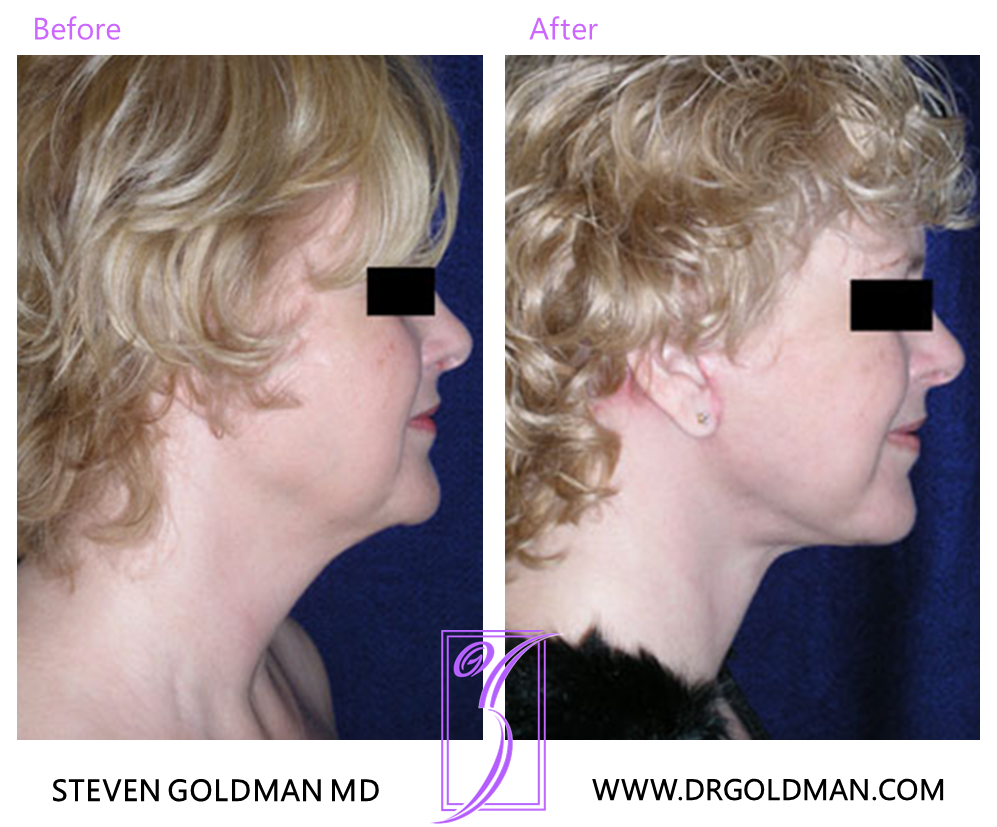 Facelift