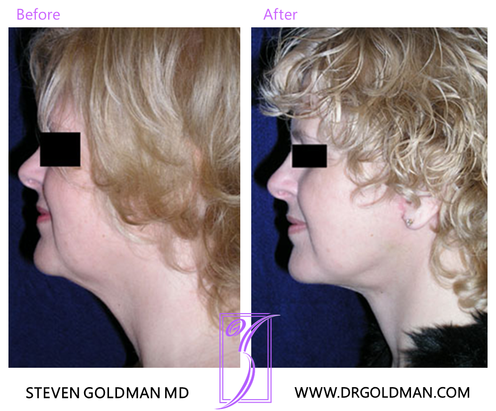 Facelift
