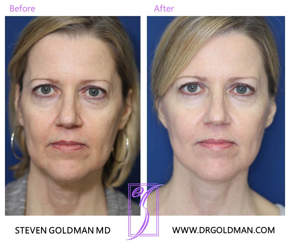 Facelift