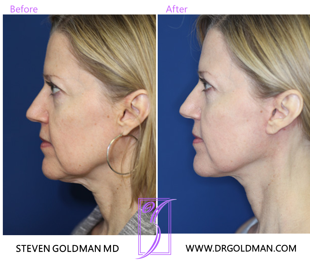 Facelift