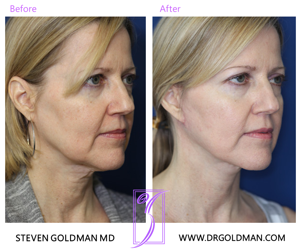 Facelift