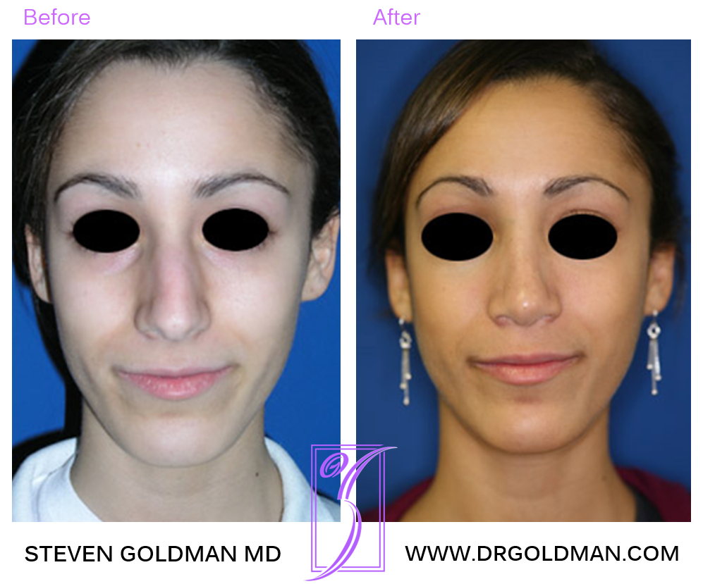 Rhinoplasty