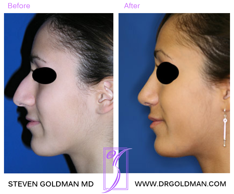 Rhinoplasty