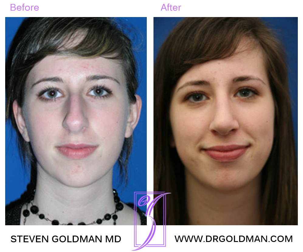 Rhinoplasty