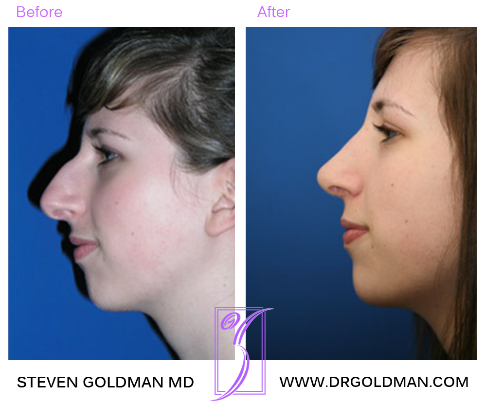 Rhinoplasty
