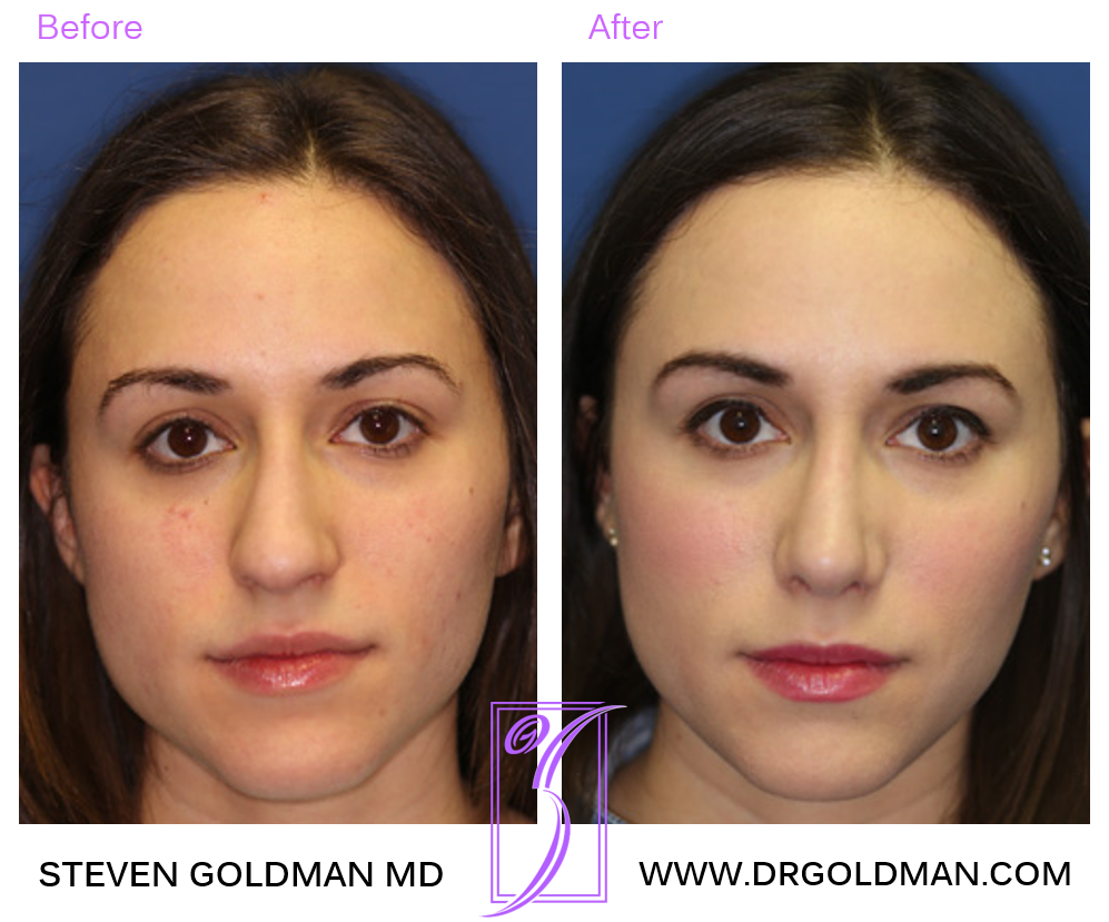 Rhinoplasty