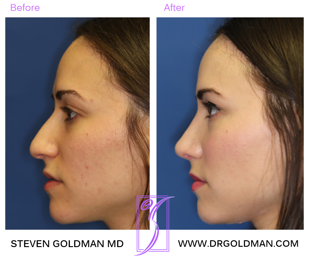 Rhinoplasty