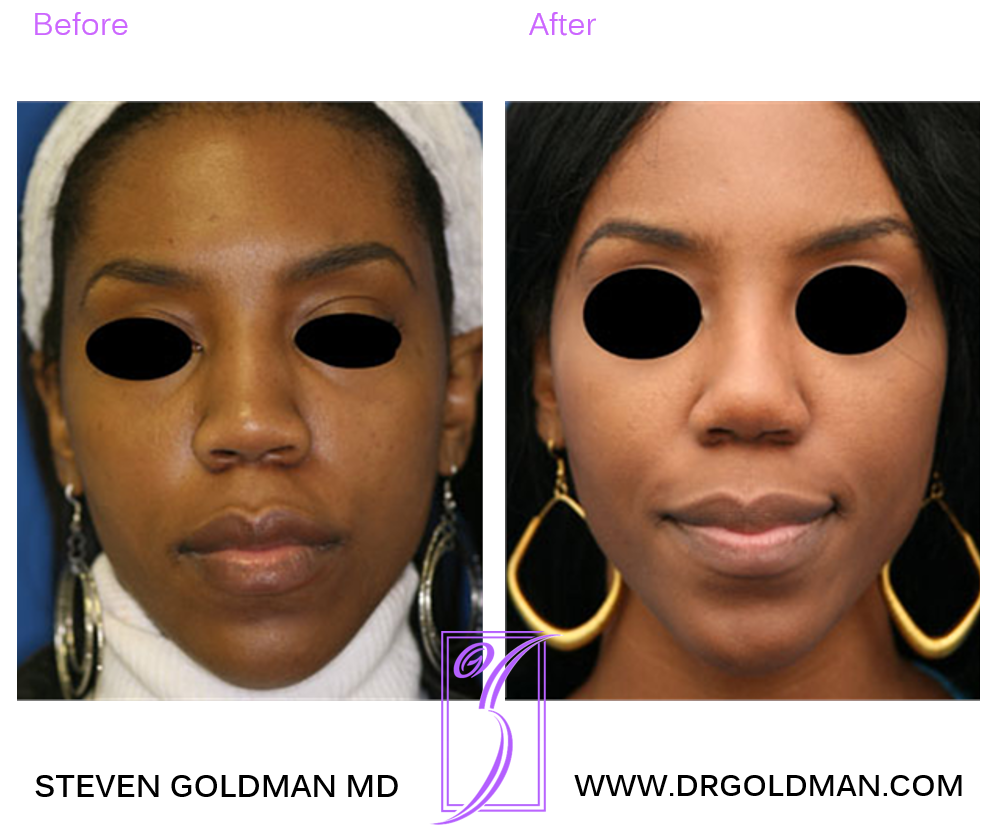 Rhinoplasty