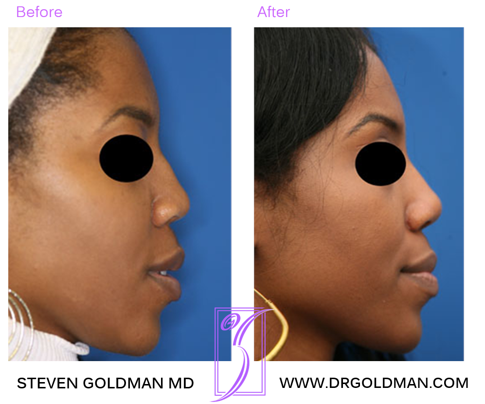 Rhinoplasty