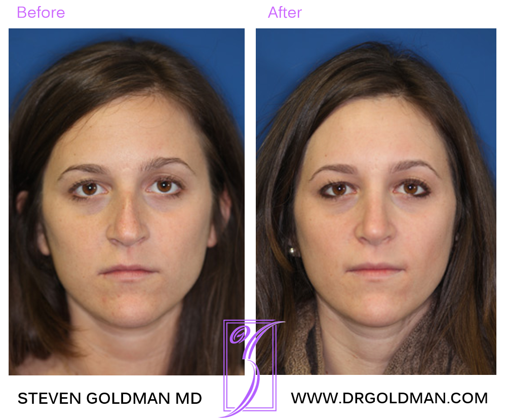 Rhinoplasty