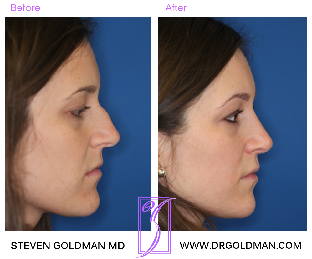 Rhinoplasty