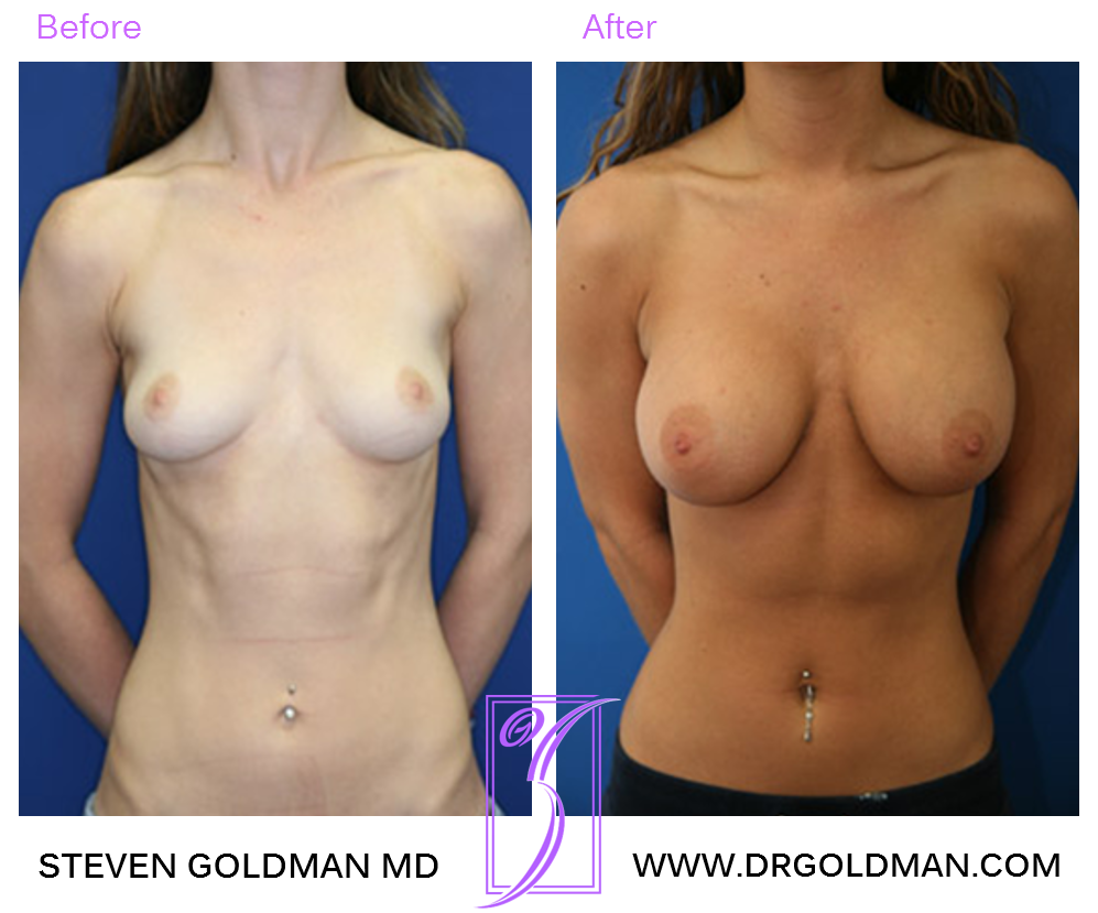 Breast Augmentation