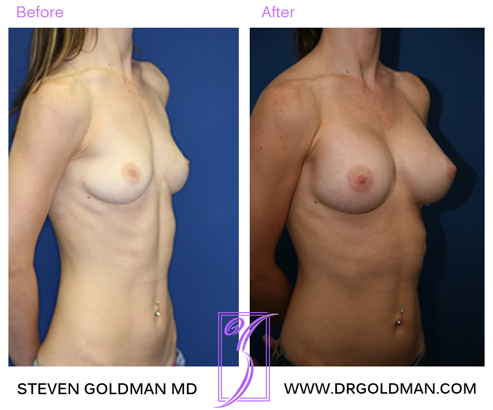 Breast Augmentation