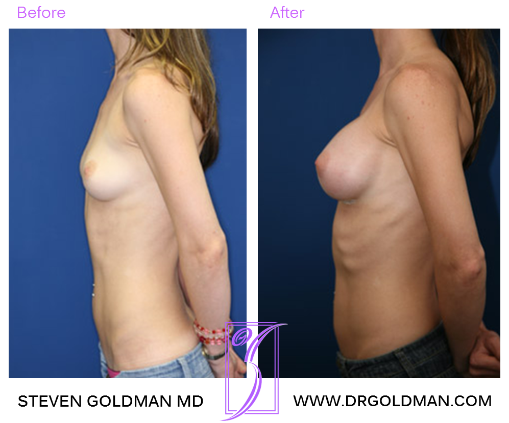 Breast Augmentation
