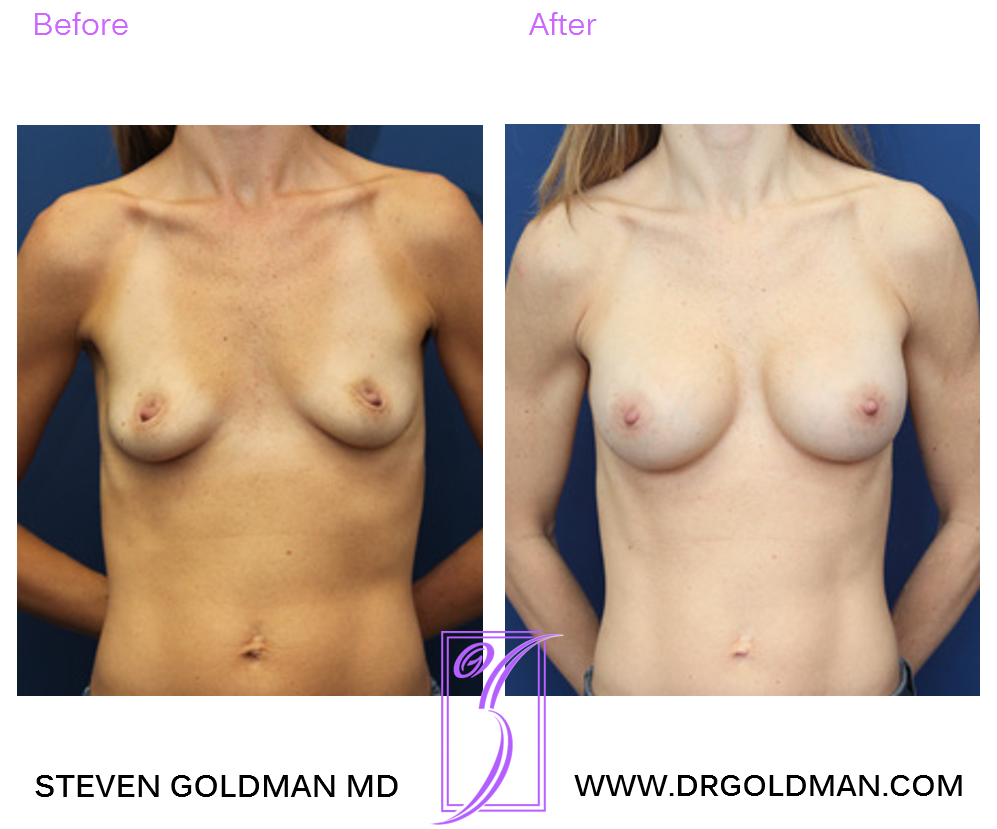 Breast Augmentation