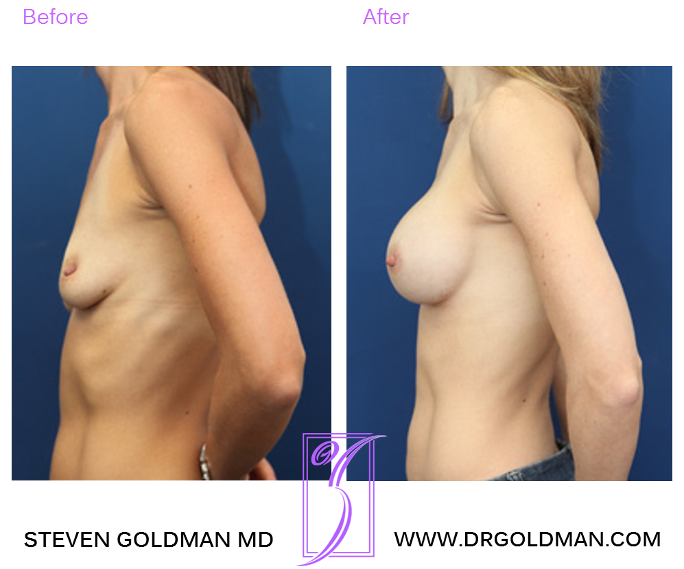 Breast Augmentation
