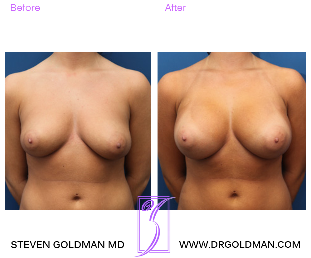 Breast Augmentation