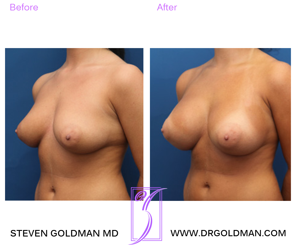 Breast Augmentation