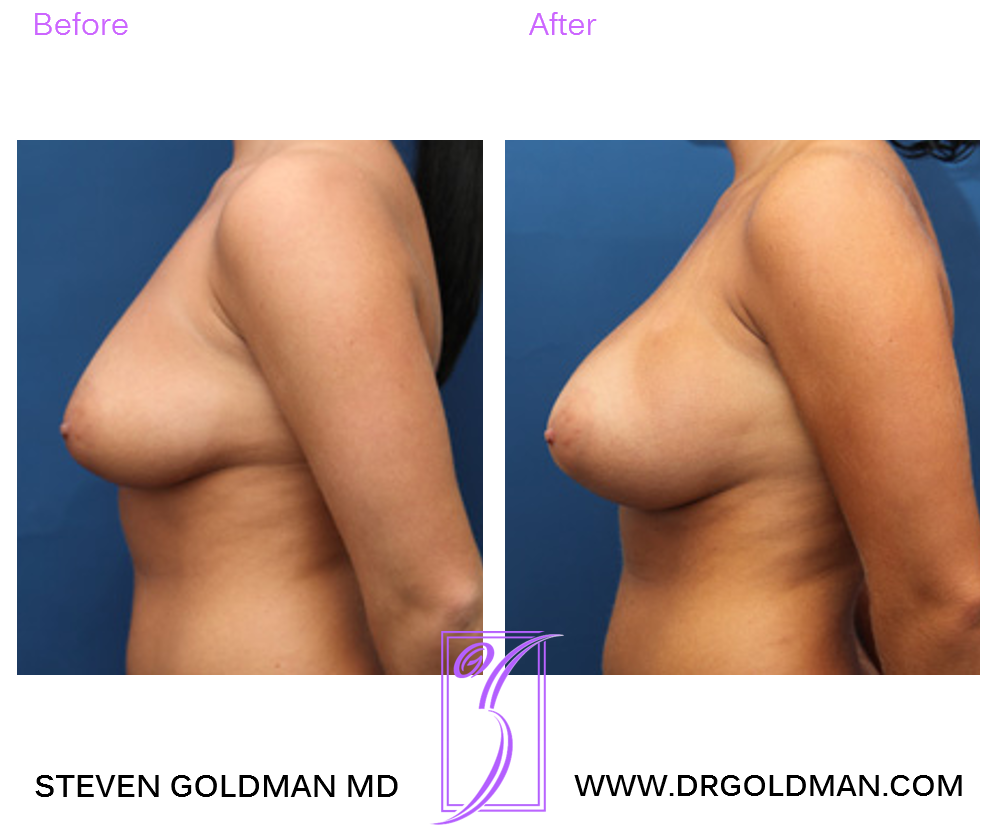 Breast Augmentation
