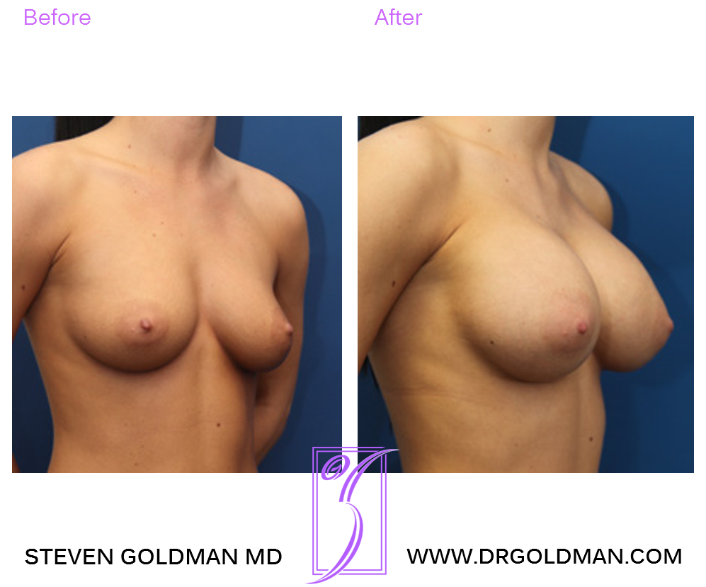 Breast Augmentation