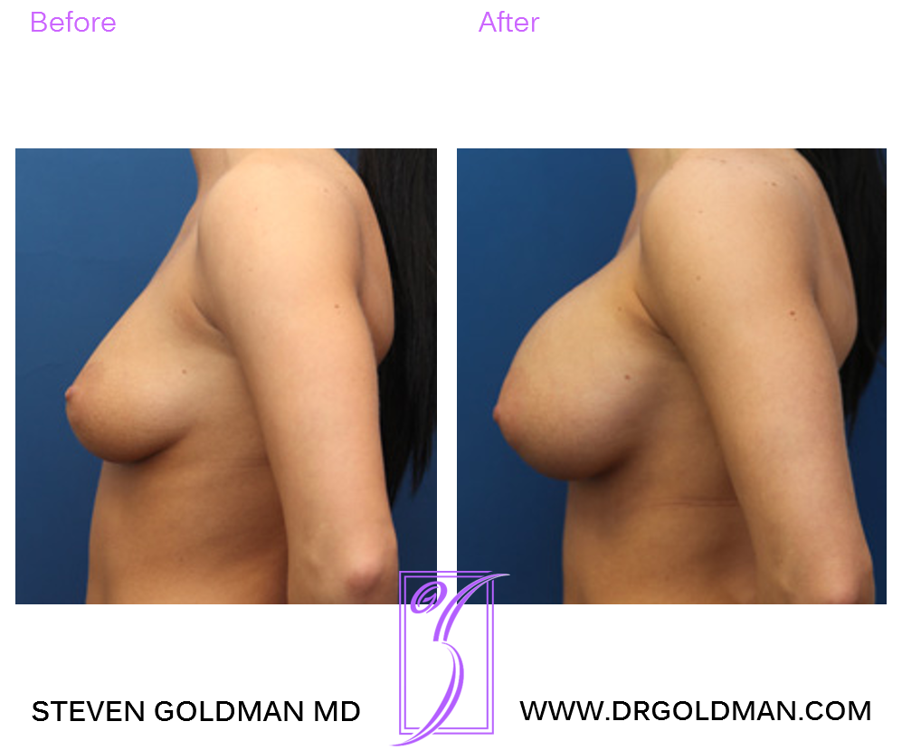Breast Augmentation