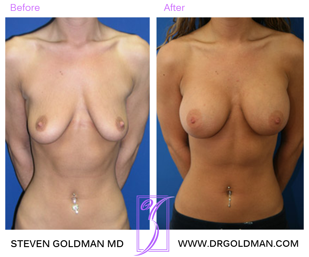 Breast Augmentation
