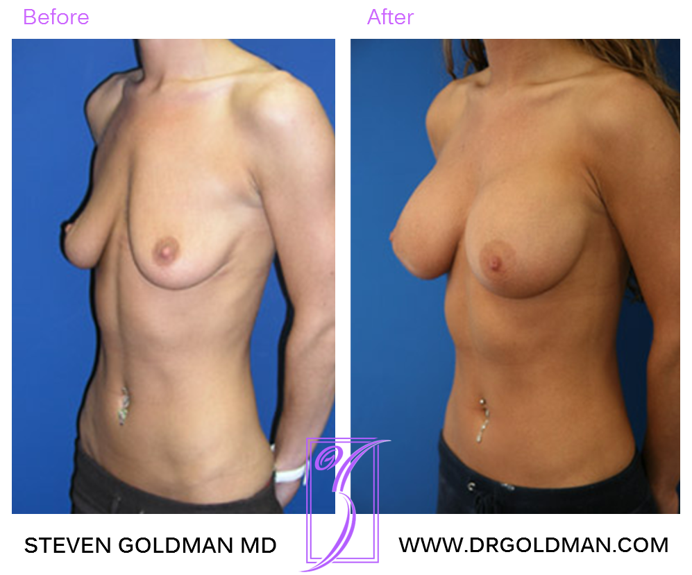 Breast Augmentation