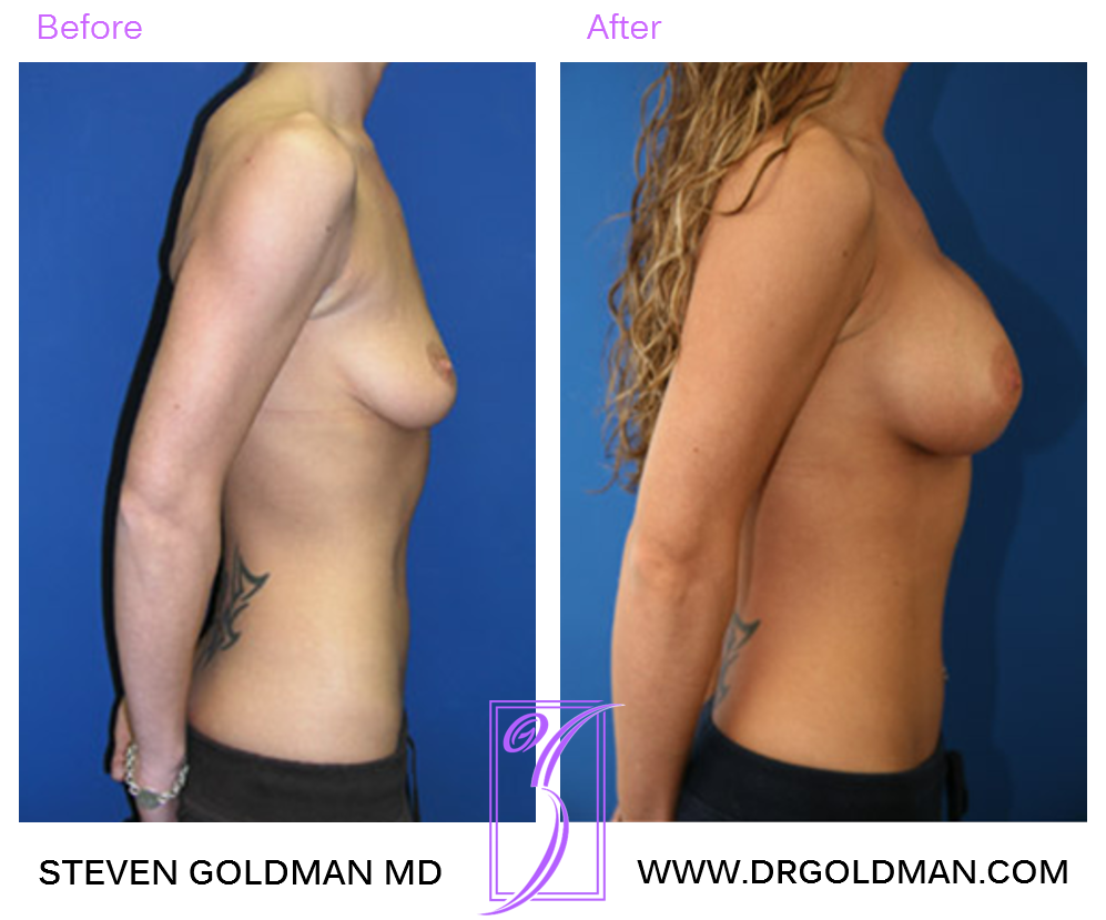 Breast Augmentation