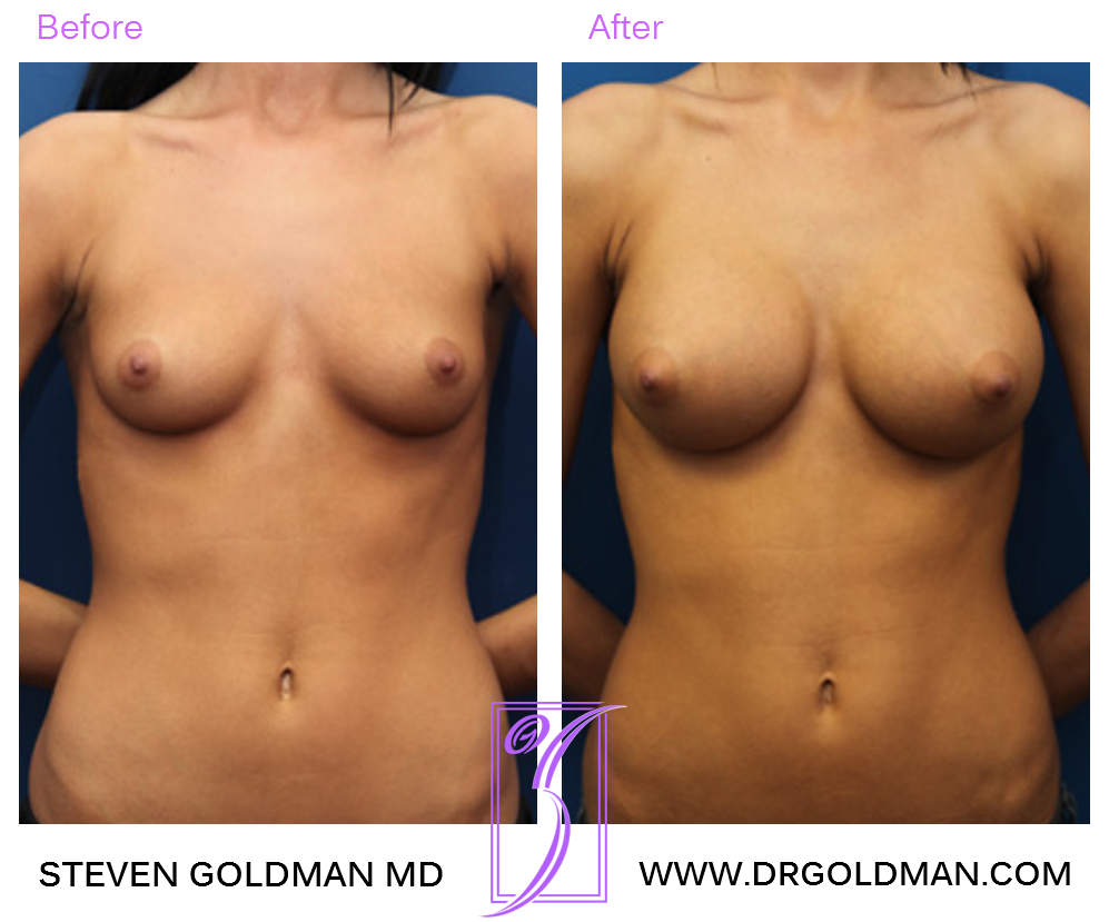 Breast Augmentation