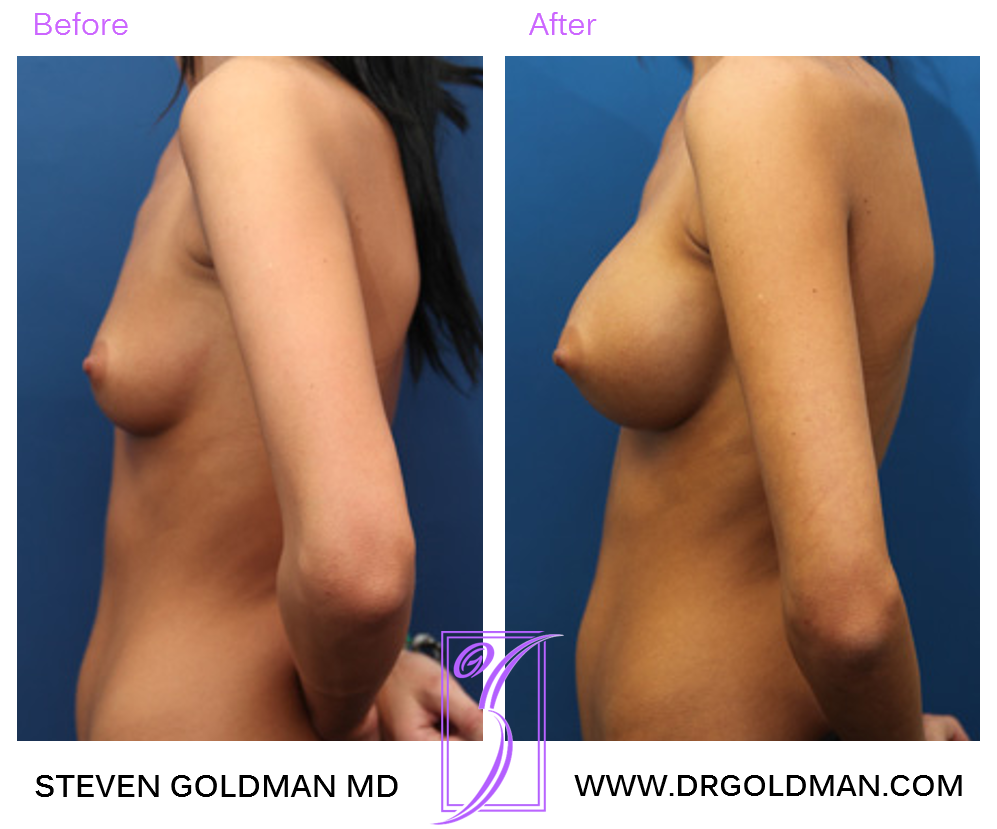 Breast Augmentation