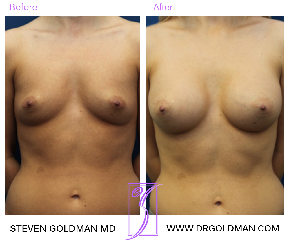 Breast Augmentation