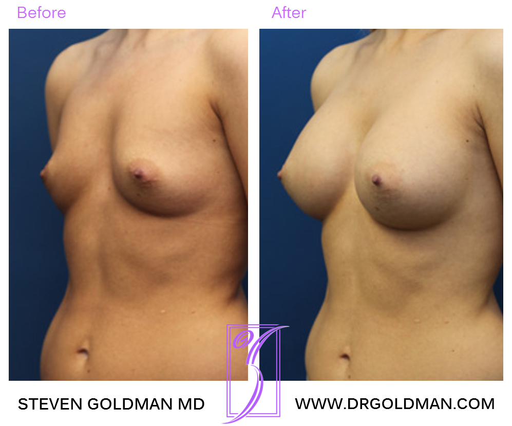 Breast Augmentation