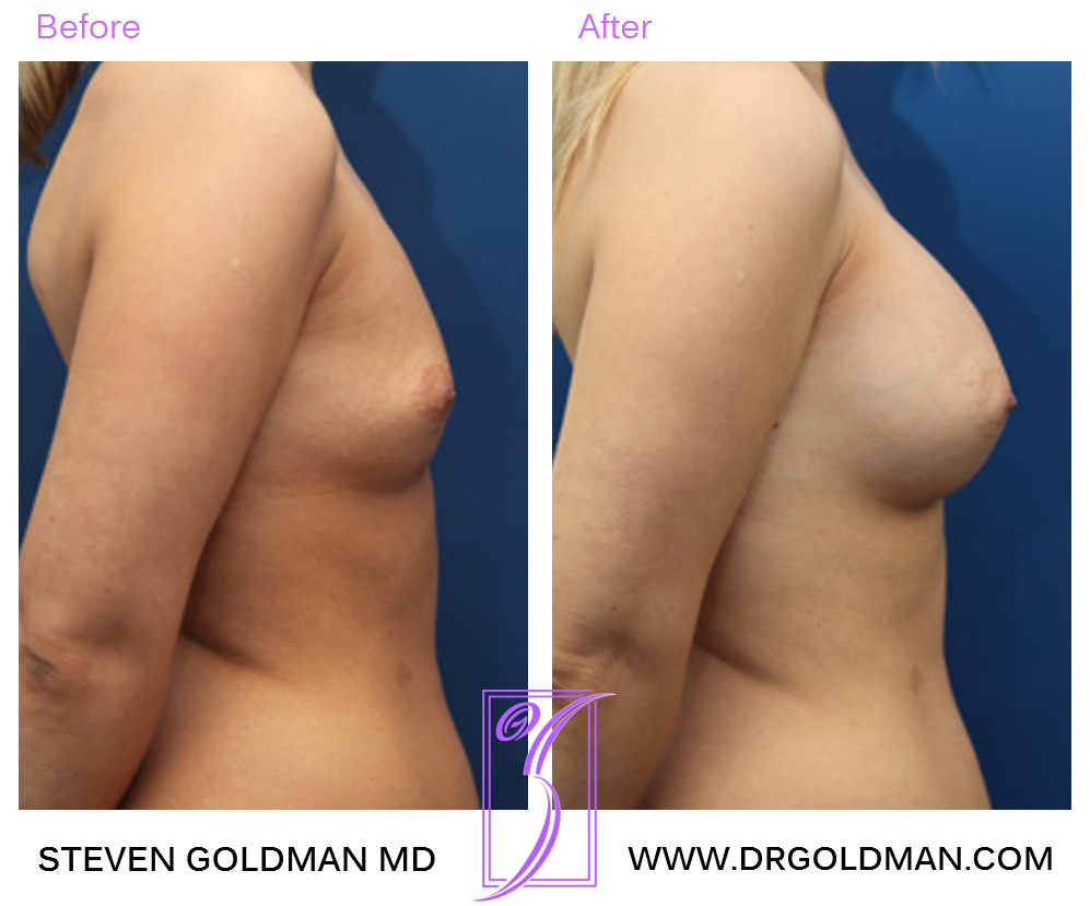Breast Augmentation