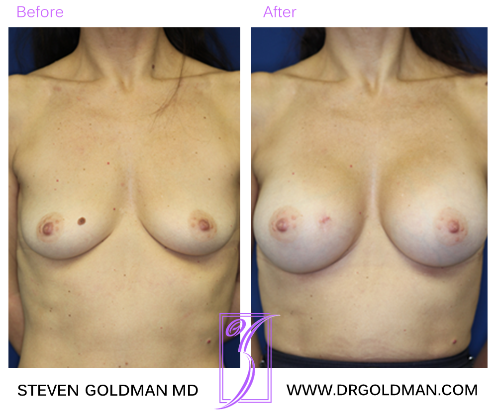 Breast Augmentation