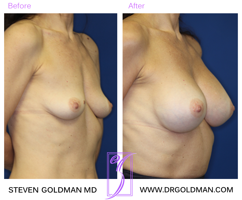 Breast Augmentation