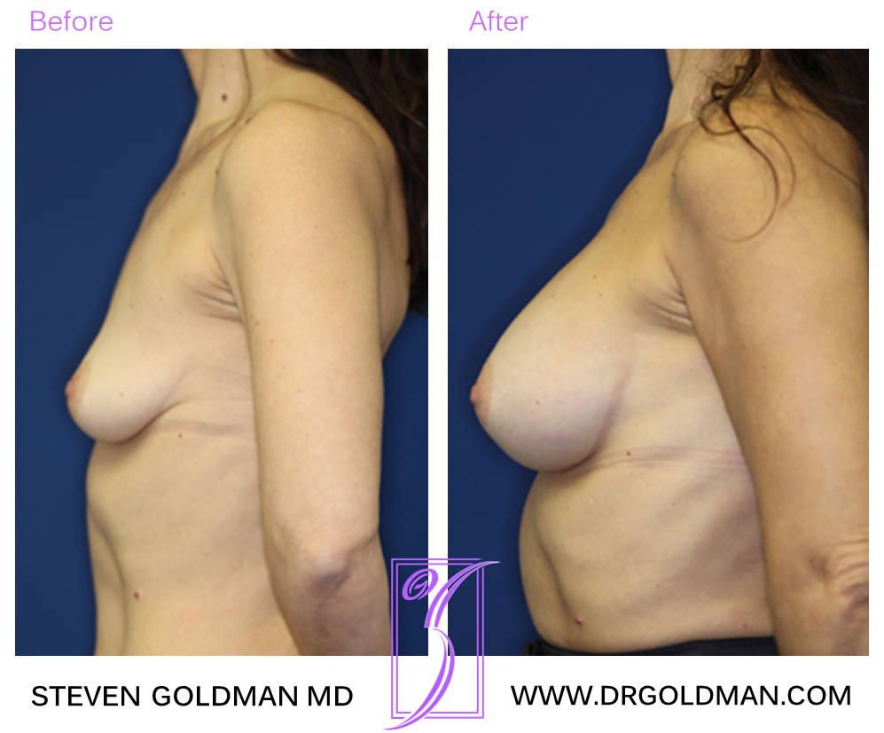 Breast Augmentation