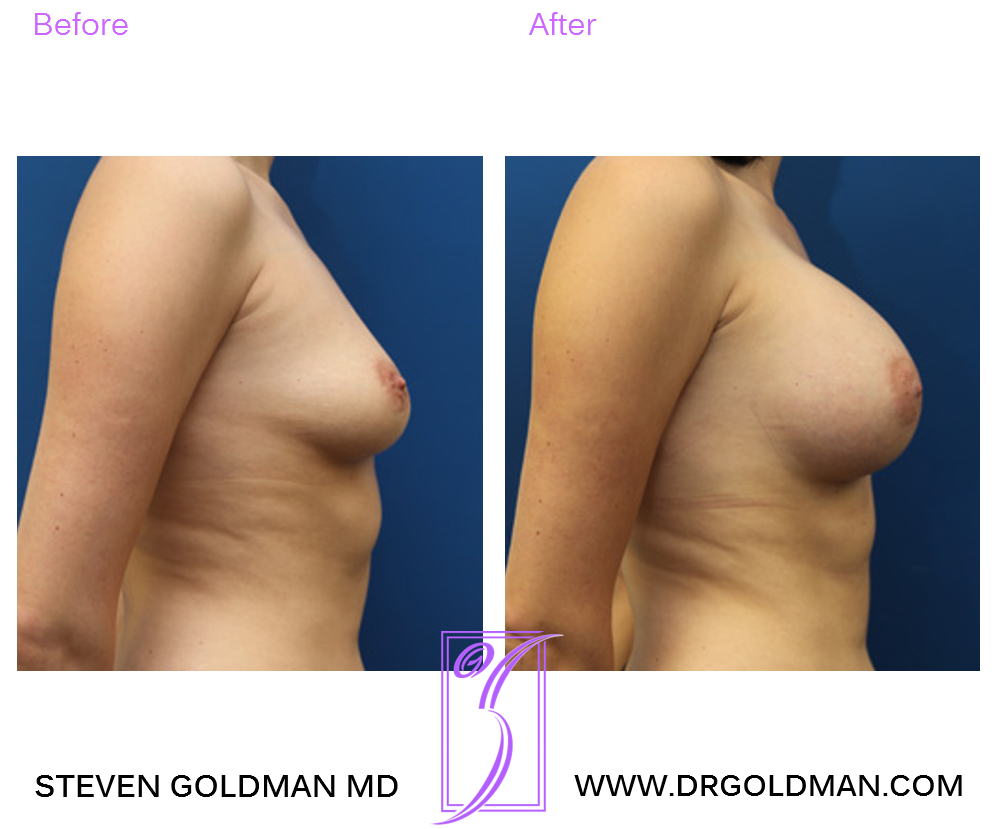 Breast Augmentation