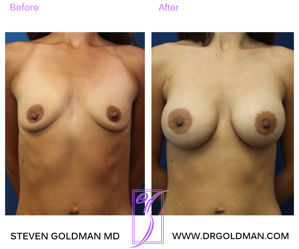 Breast Augmentation