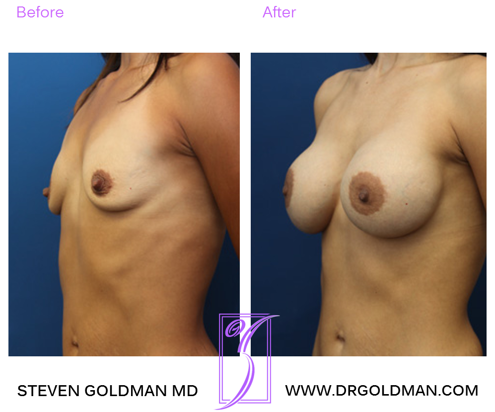 Breast Augmentation
