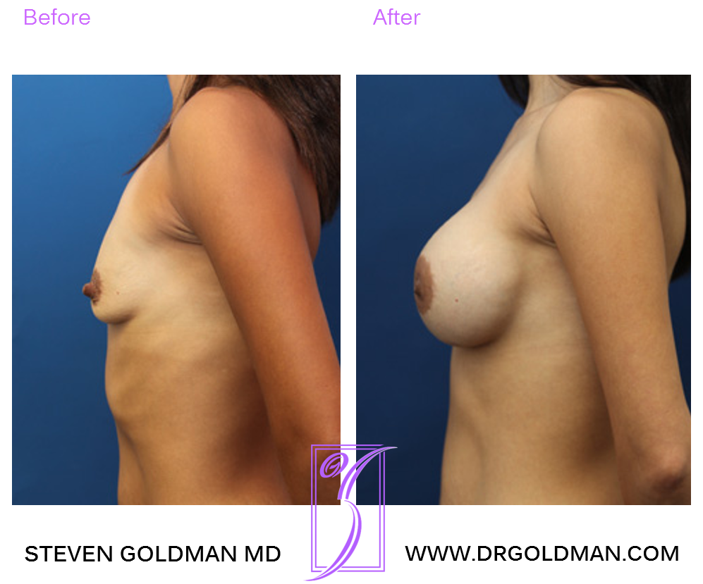 Breast Augmentation