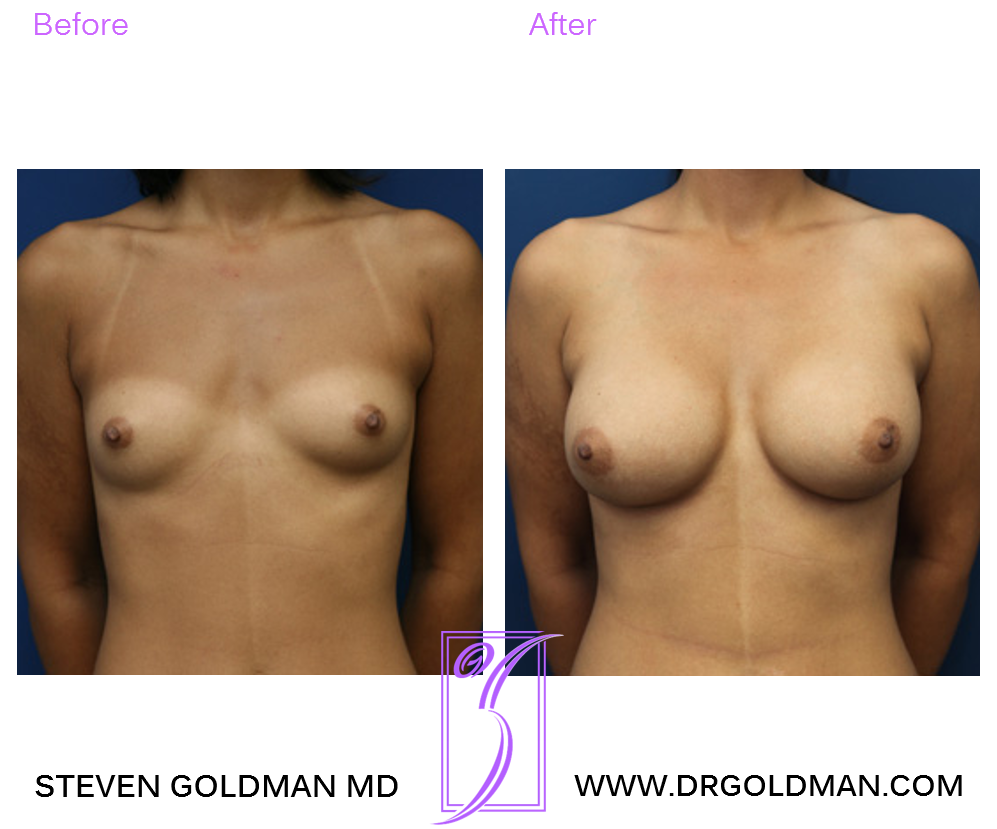Breast Augmentation
