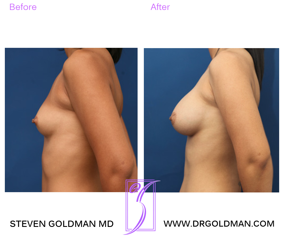 Breast Augmentation