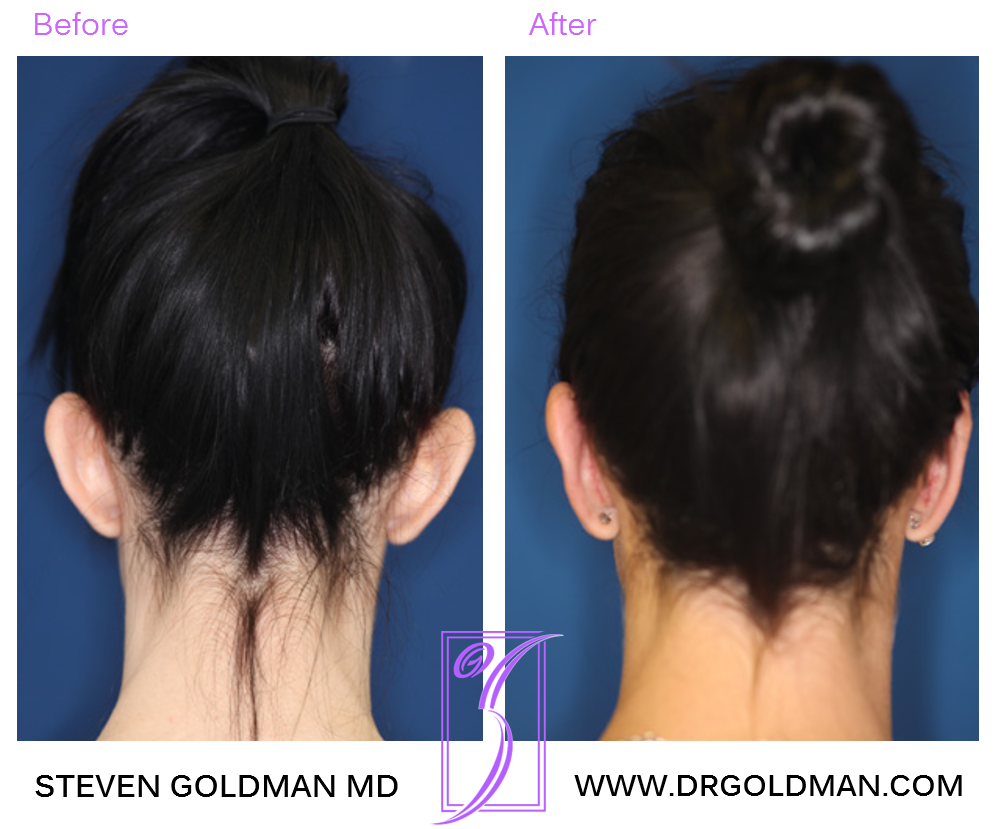 Otoplasty
