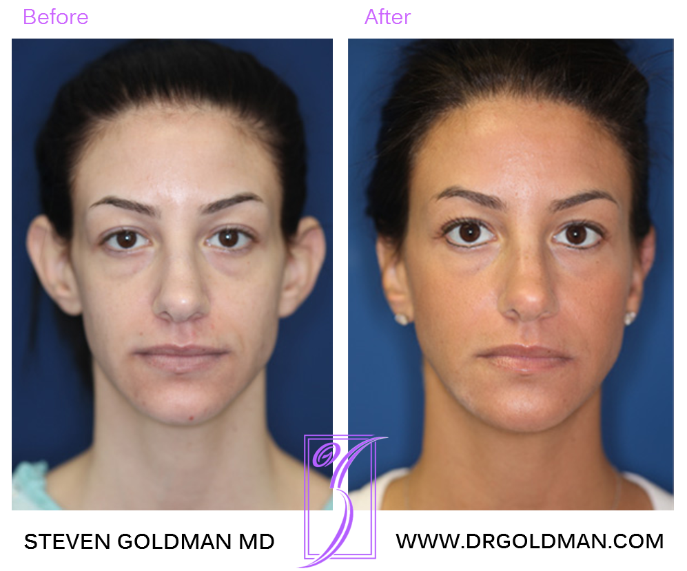 Otoplasty